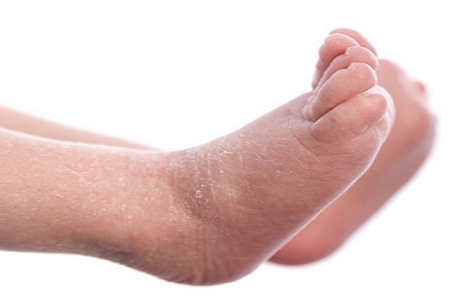 da bàn chân trẻ sơ sinh bị khô