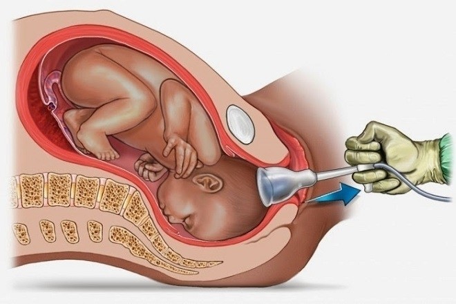 mô tả kĩ thuật hút thai như thế nào