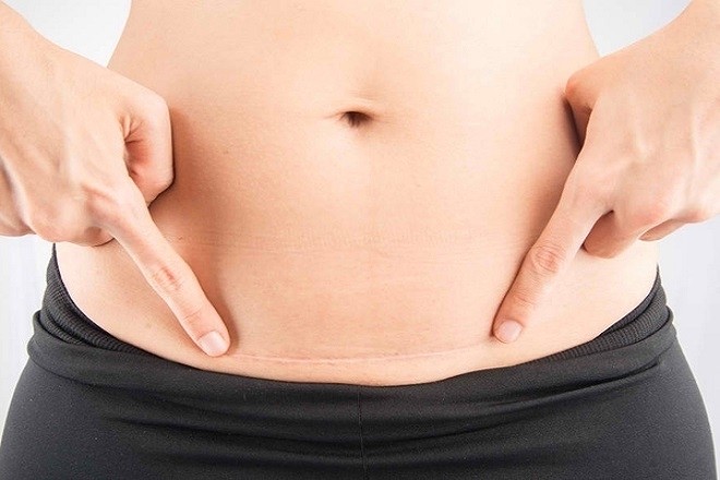 vết mổ sau khi sinh