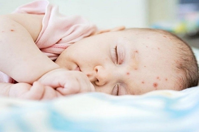 bé bị nổi mẩn đỏ khắp người