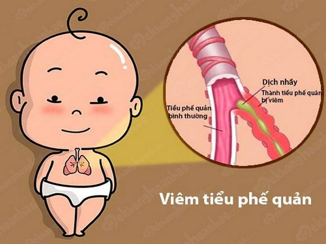 bé sơ sinh thở khò khè có thể do viêm tiểu phế quản