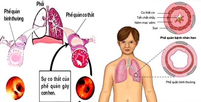 Hen phế quản khiến bé sơ sinh thở khò khè