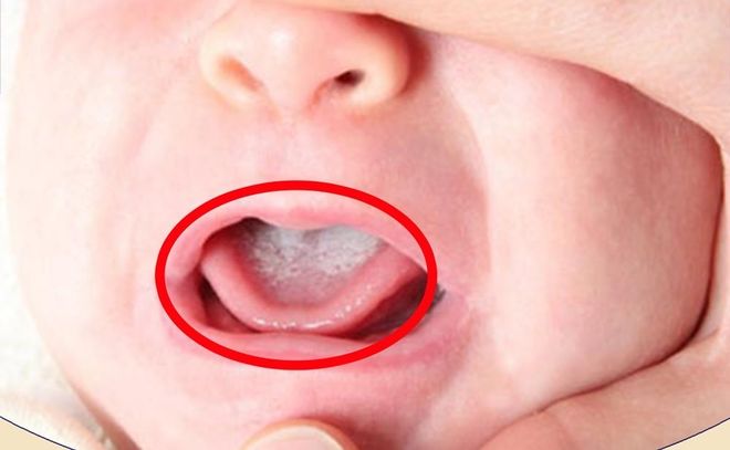 lưỡi trẻ sơ sinh dính mảng bám trắng