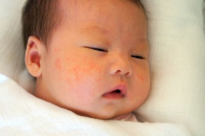 trẻ sơ sinh bị nổi mụn nước