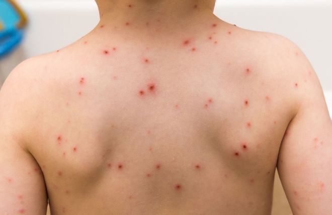 lưng bé bị bệnh sởi