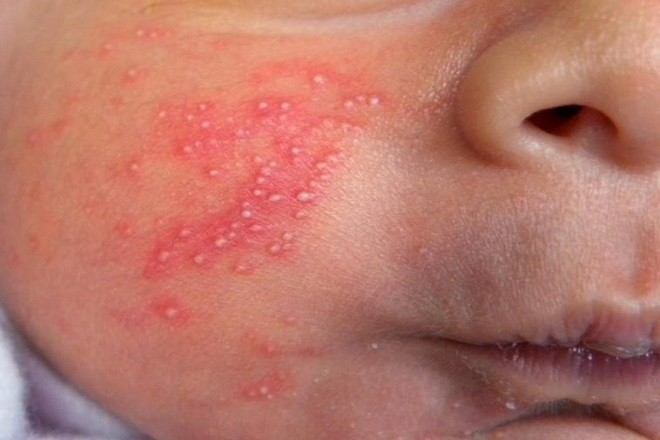 mụn nước ở trẻ sơ sinh