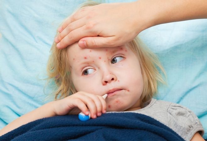 trẻ sốt vì nổi ban sởi