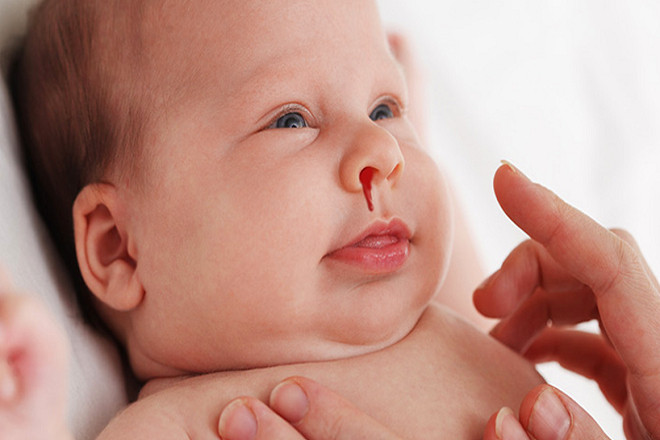 bệnh chảy máu cam ở trẻ em có thể gây nhiều biến chứng nguy hiểm