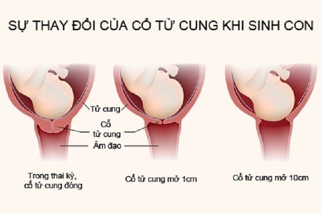 Cổ tử cung giãn nở