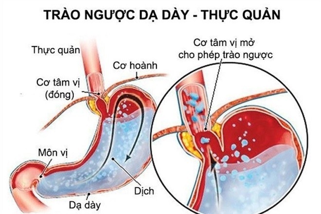 trào ngược dạ dày