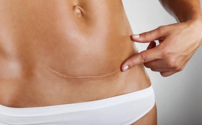 Các vết mổ sau sinh sinh có khả năng bị viêm, nhiễm trùng