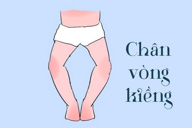 tình trạng vòng kiềng làm giảm thẩm mĩ cho chân bé