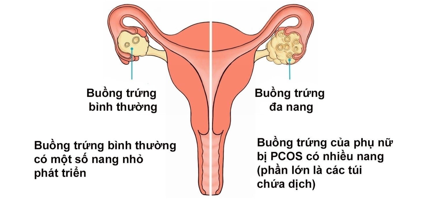 Buồng trứng đa nang là một căn bệnh phụ khoa và thường bị ở những phụ nữ có nhiều nang nhỏ