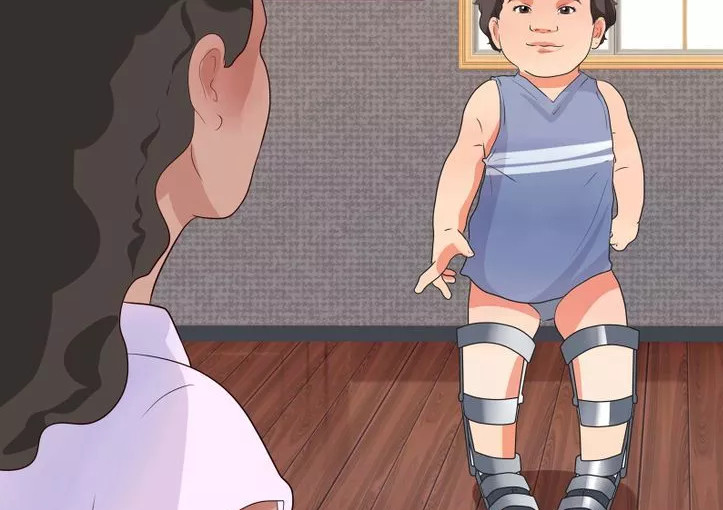 niềng chân là một trong những cách chữa chân vòng kiềng cho bé hiệu quả