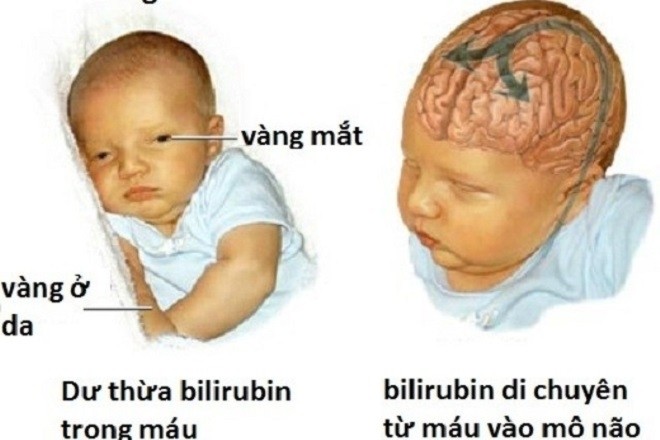 trẻ sơ sinh bị vàng mắt