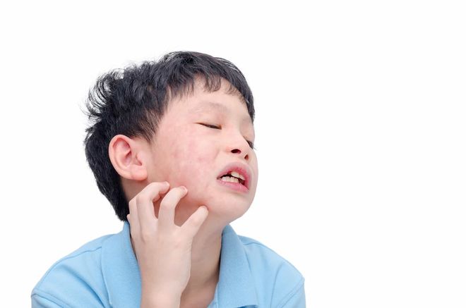 phản ứng phụ khi tiêm ngừa quai bị