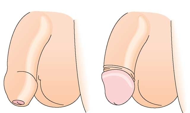 có nên cắt bao quy đầu cho trẻ sơ sinh
