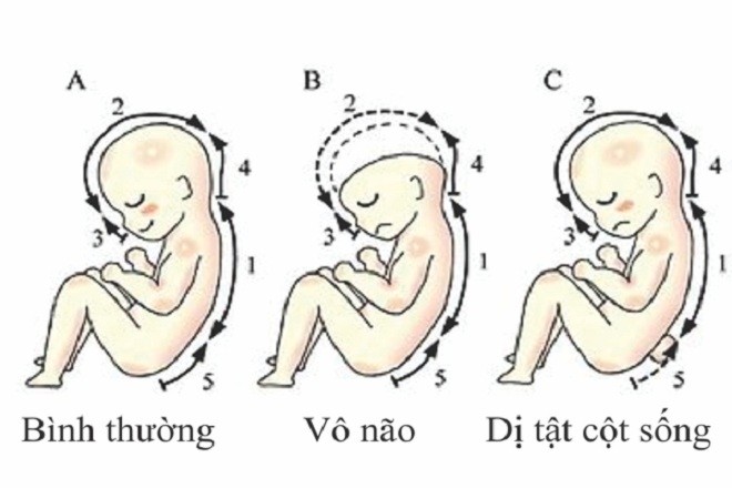 Dị tật ống thần kinh