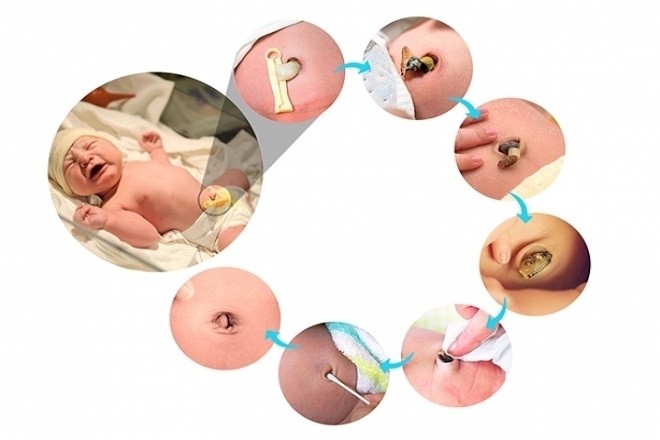 quá trình rụng chồi rốn ở trẻ sơ sinh