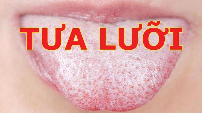 tưa lưỡi