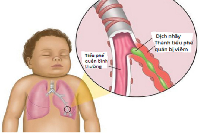 trẻ sơ sinh bị đờm