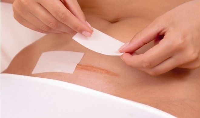 viêm trùng vết mổ nếu sau khi sinh quan hệ quá sớm