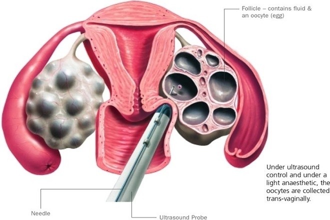Chọc hút trứng là một quy trình quan trọng của IVF,