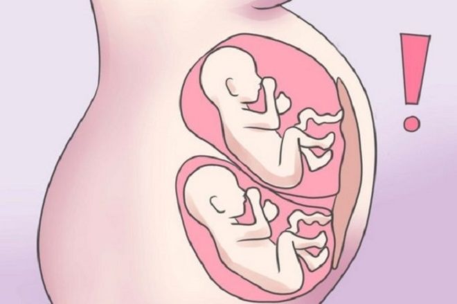 thụ tinh trong ống nghiệm có tỷ lệ đa thai cao