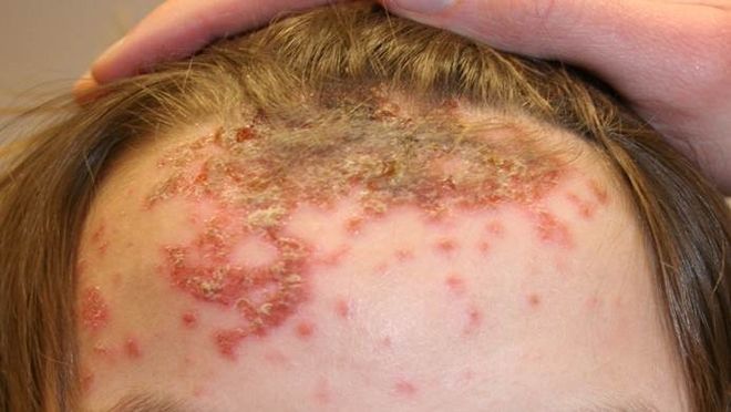 bệnh chốc trán ở trẻ em