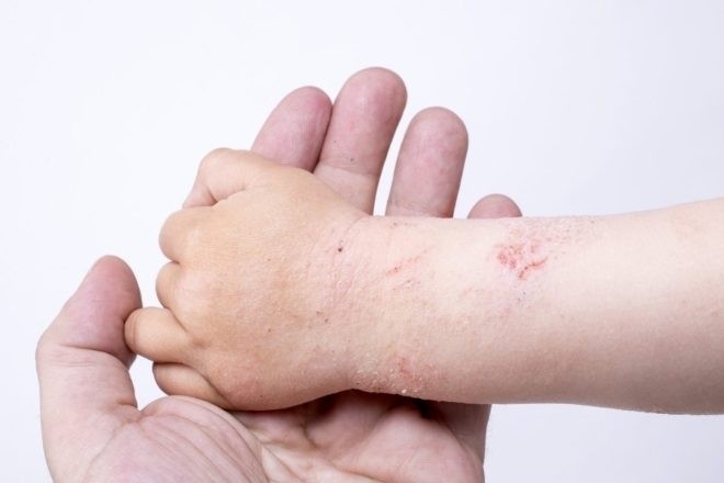 bệnh á sừng ở trẻ em