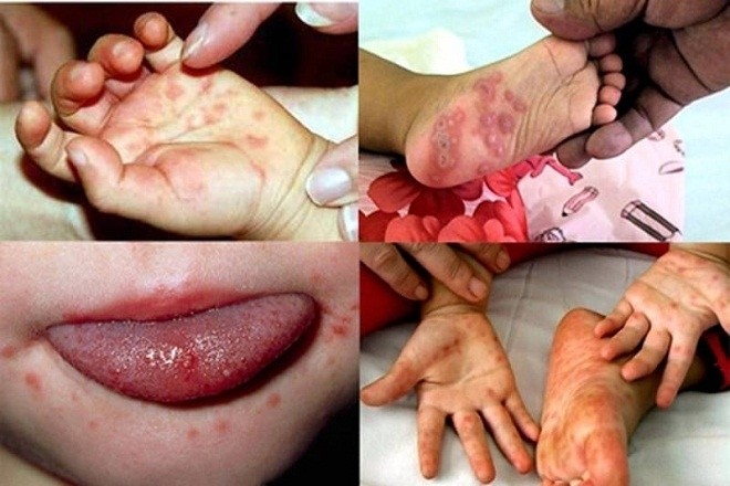 bệnh tay chân miệng có thể gây nhiều biến chứng nguy hiểm