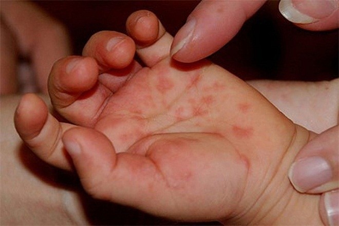 bệnh tay chân miệng do virus Enterovirus EV71 gây ra