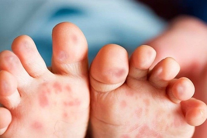 nổi bóng nước đỏ ở lòng bàn chân là một trong các triệu chứng bệnh tay chân miệng