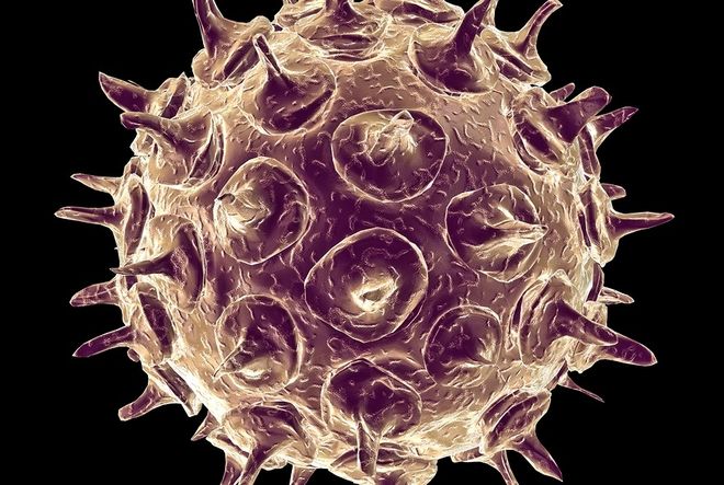 virus varicella zoster