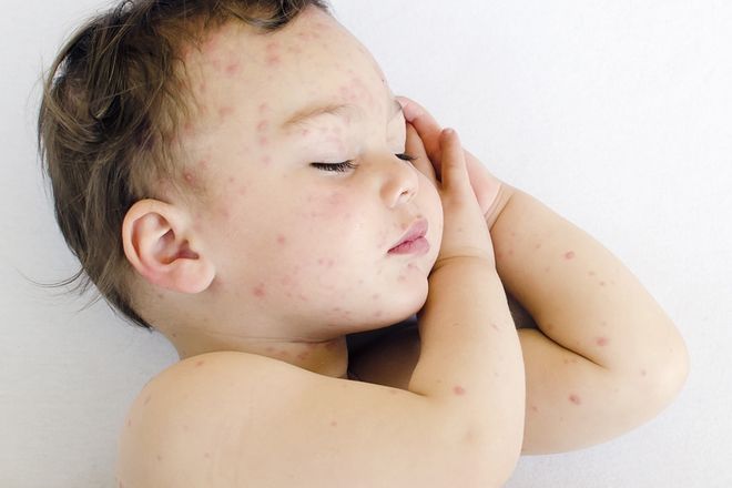 bé nổi ban đỏ đang nằm ngủ