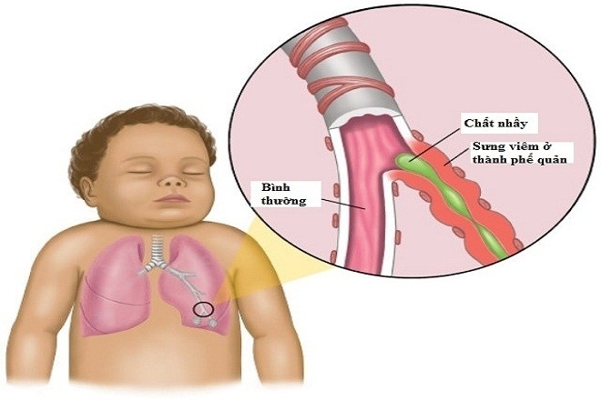 trẻ sơ sinh bị ho có đờm có thể là do bị viêm phế quản