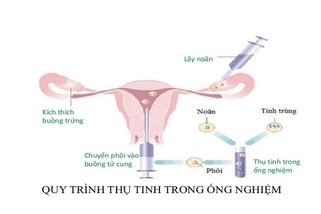 quy trình thụ tinh nhân tạo IVF