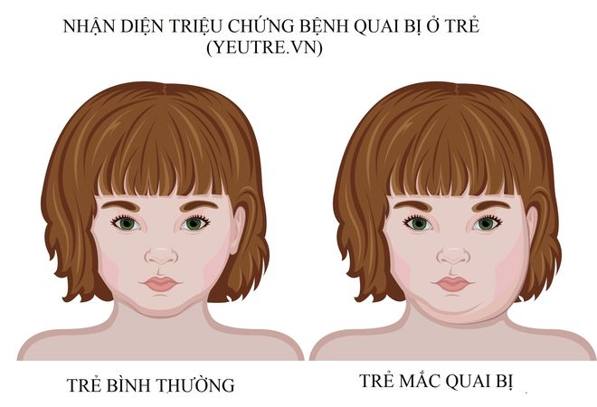 trẻ sưng phồng tuyến mang tai