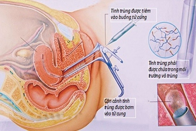 Quy trình thụ tinh nhân tạo bằng phương pháp bơm tinh trùng vào cổ tử cung