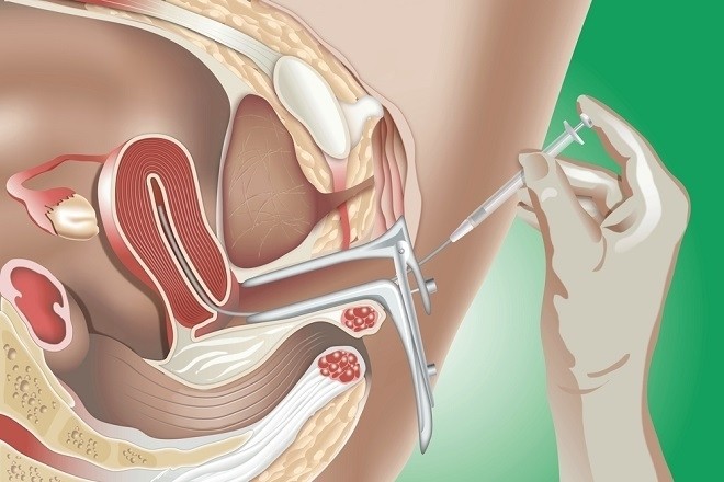Bơm tinh trùng vào buồng tử cung (IUI) là phương pháp điều trị hiếm muộn