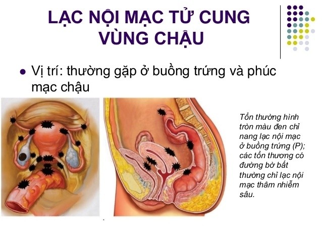 lạc nội mạc tử cung