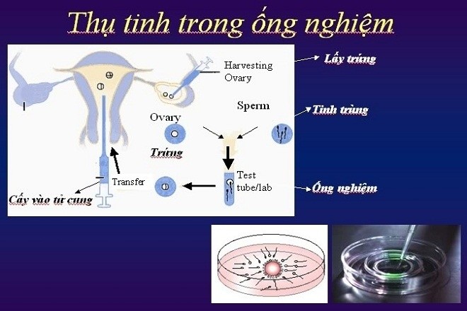 thụ tinh trong ống nghiệm để sinh đôi là phương pháp hỗ trợ sinh sản hiệu quả cho vợ chồng hiếm muộn