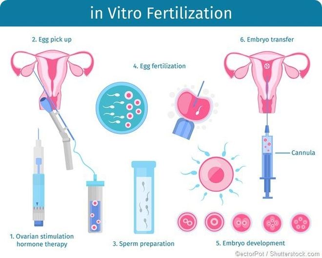 thụ tinh ống nghiệm ivf