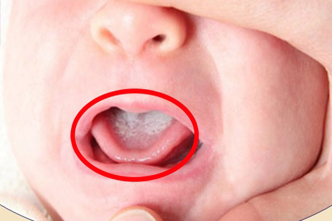 Trẻ bị tưa lưỡi