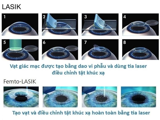 lasik
