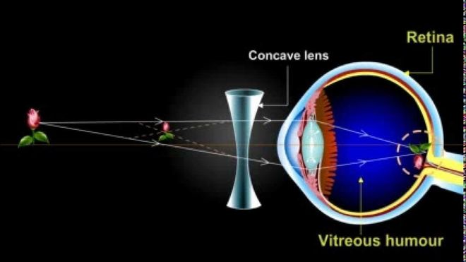 đeo kính khắc phục cận thị