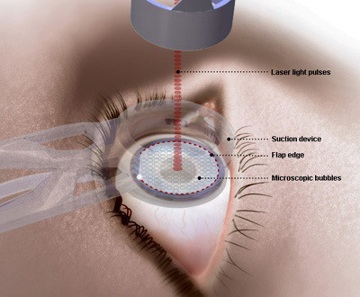 phau thuat laser