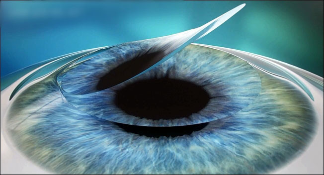 phau thuat lasik