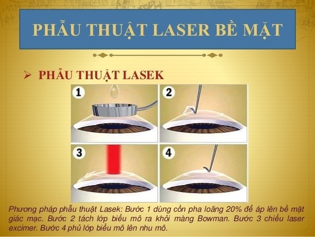 phau-thuat-lasek