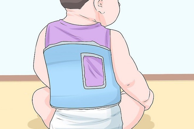 áo nẹp gù lưng cho trẻ